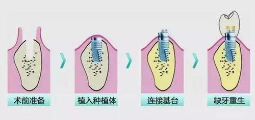 爆料种植牙套路视频播放,视频曝光惊人内幕 第3张 爆料种植牙套路视频播放,视频曝光惊人内幕 第3张